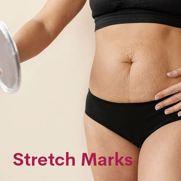 Stretch Marks What Causes Stretch Marks WUKA