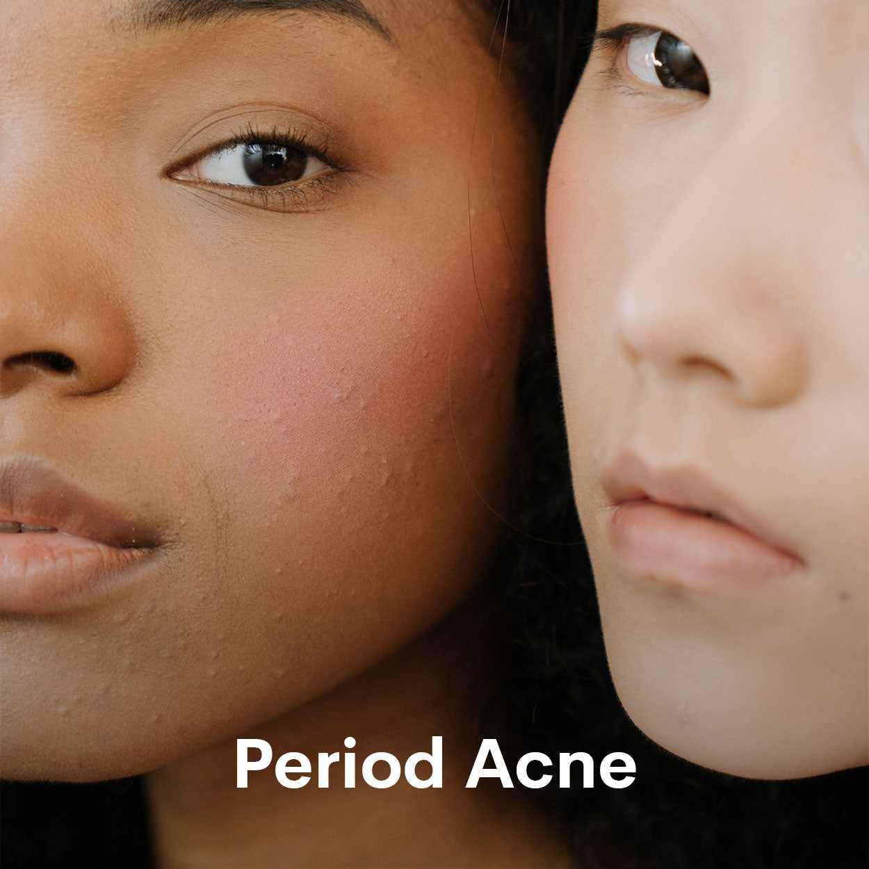 Perorod Period Acne | Period Breakouts | WUKA